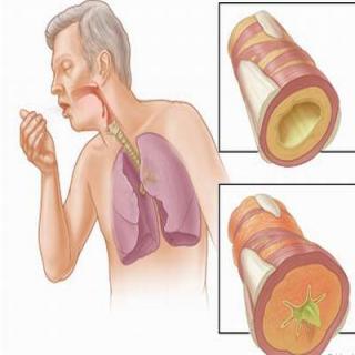 Điều trị viêm phế quản bằng đông trùng hạ thảo Điều trị viêm phế quản bằng đông trùng hạ thảo